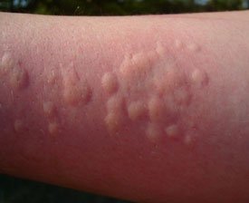 Аллергия — симптомы, причины и лечение аллергии